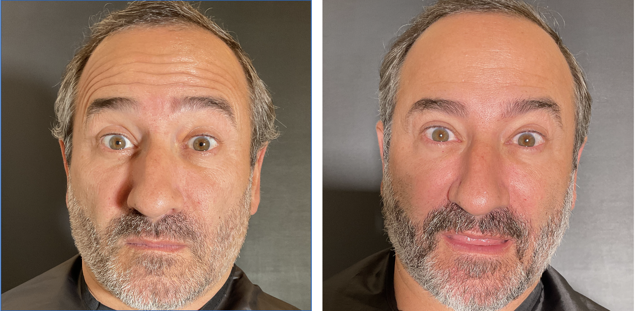 Resultado Botox