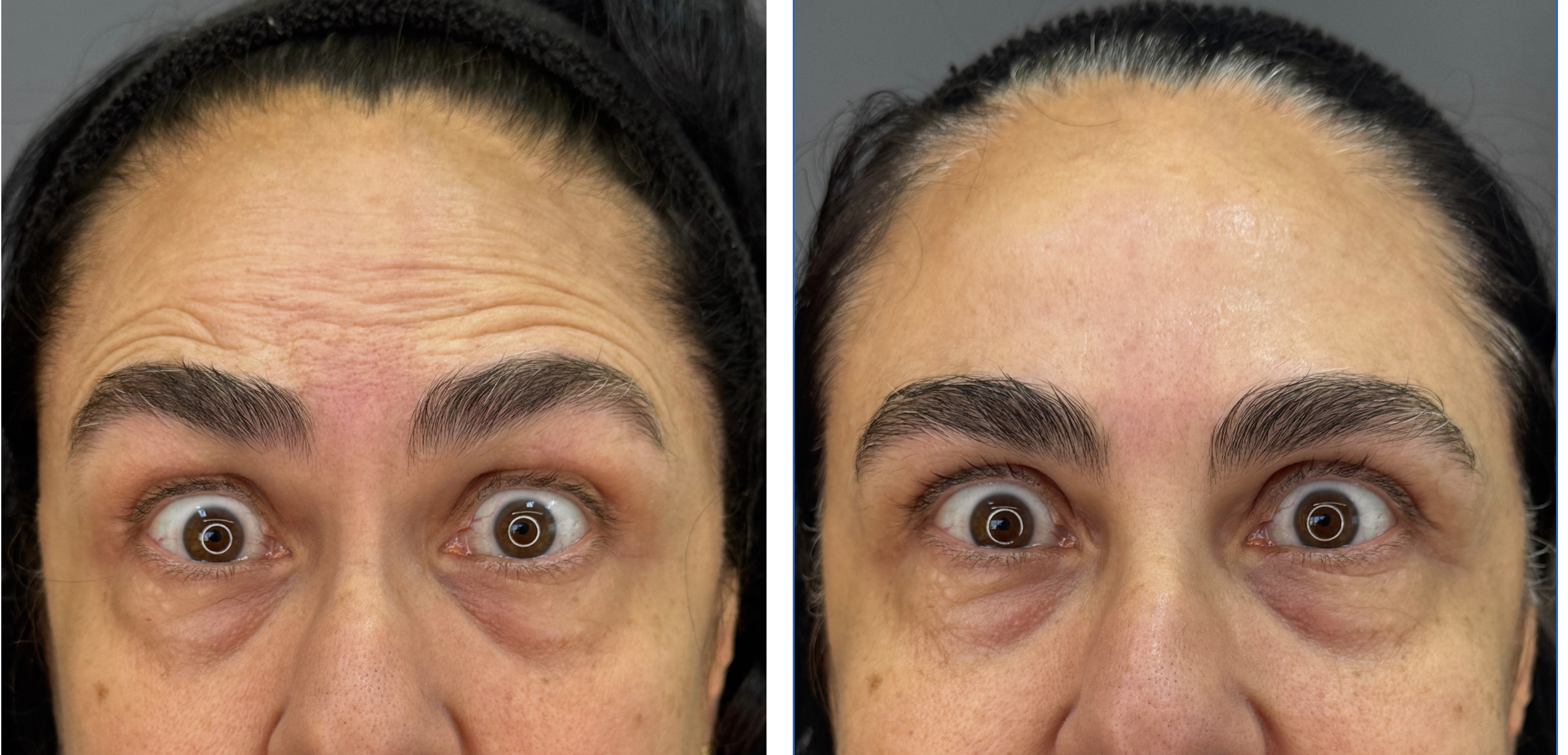 Resultado Botox