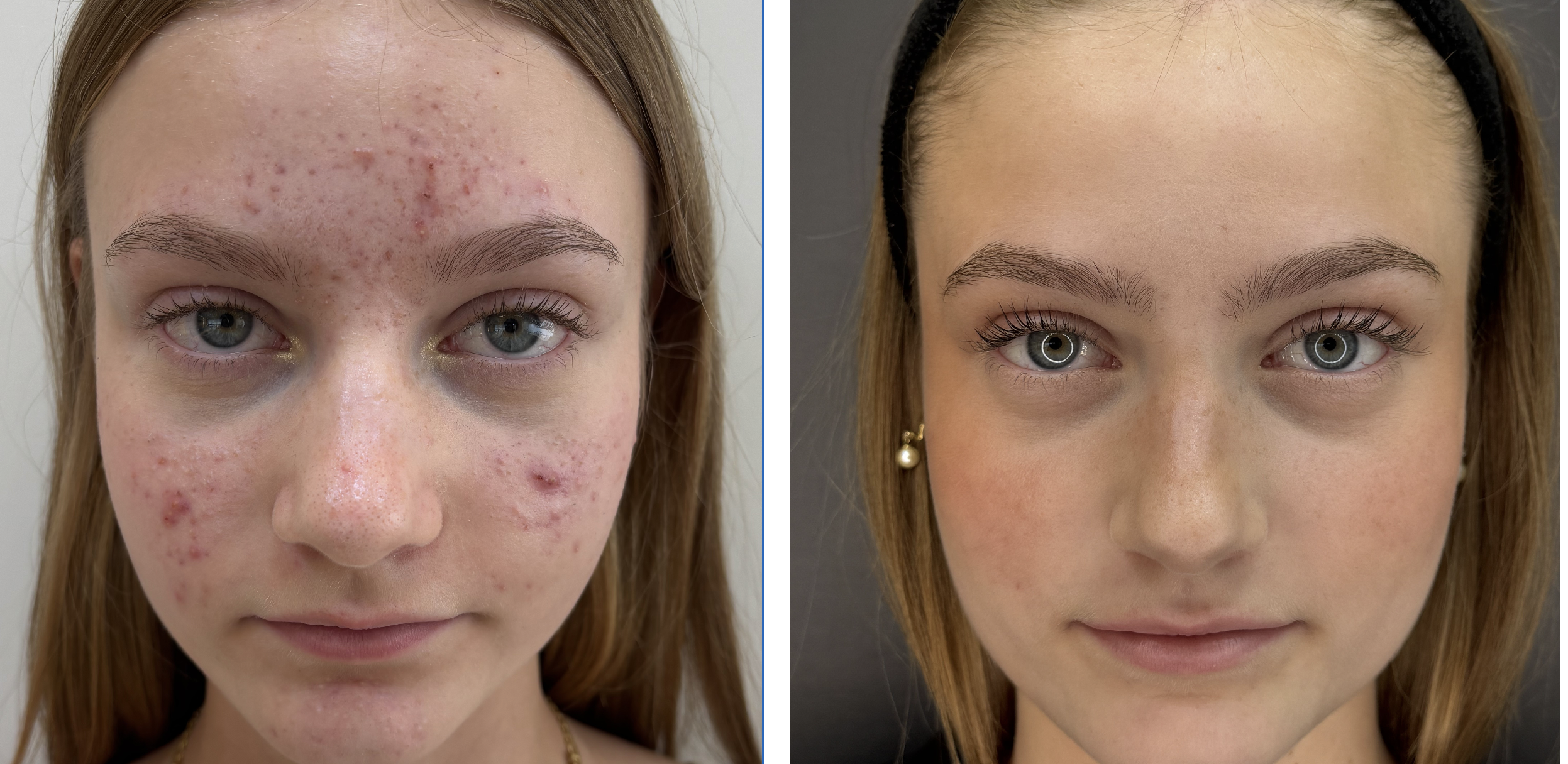 Resultado Acne
